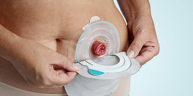 Colostomy Bag Change at home 